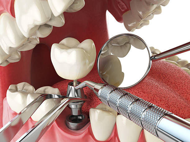 Best Emergency Broken Tooth Repair in Keaau, HI